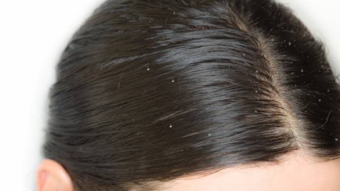 ریزش مو چیست و چطور می‌توان آن را درمان کرد؟