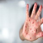 مصاحبه دکتر ناصح در مورد بیماری سرخک و وضعیت شهرستان شهریار